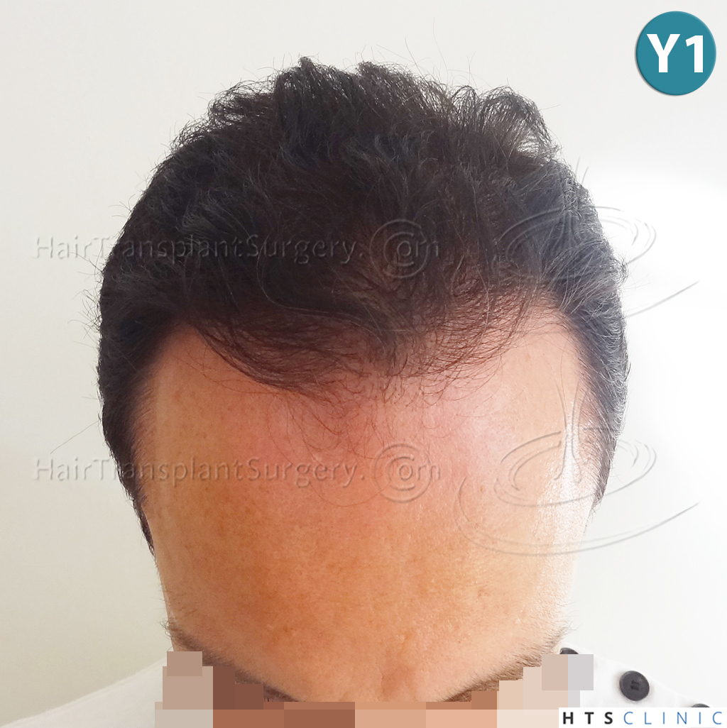 Dr.Devroye-HTS-clinic-3178-FUE-NW-VI-17.jpg