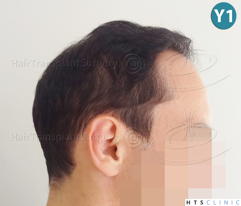 Dr.Devroye-HTS-clinic-3178-FUE-NW-VI-19.jpg