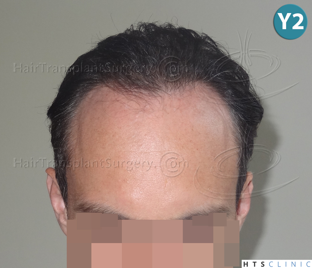 Dr.Devroye-HTS-clinic-3178-FUE-NW-VI-21.jpg