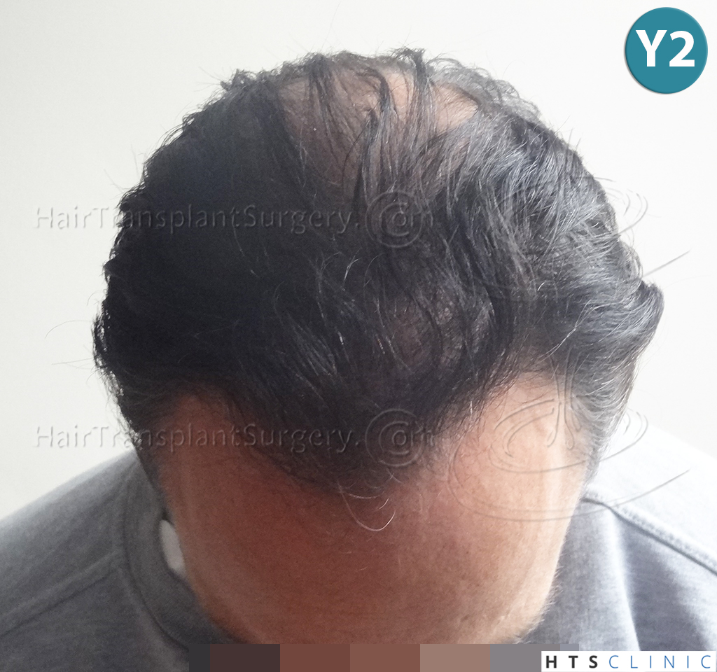 Dr.Devroye-HTS-clinic-3178-FUE-NW-VI-22.jpg