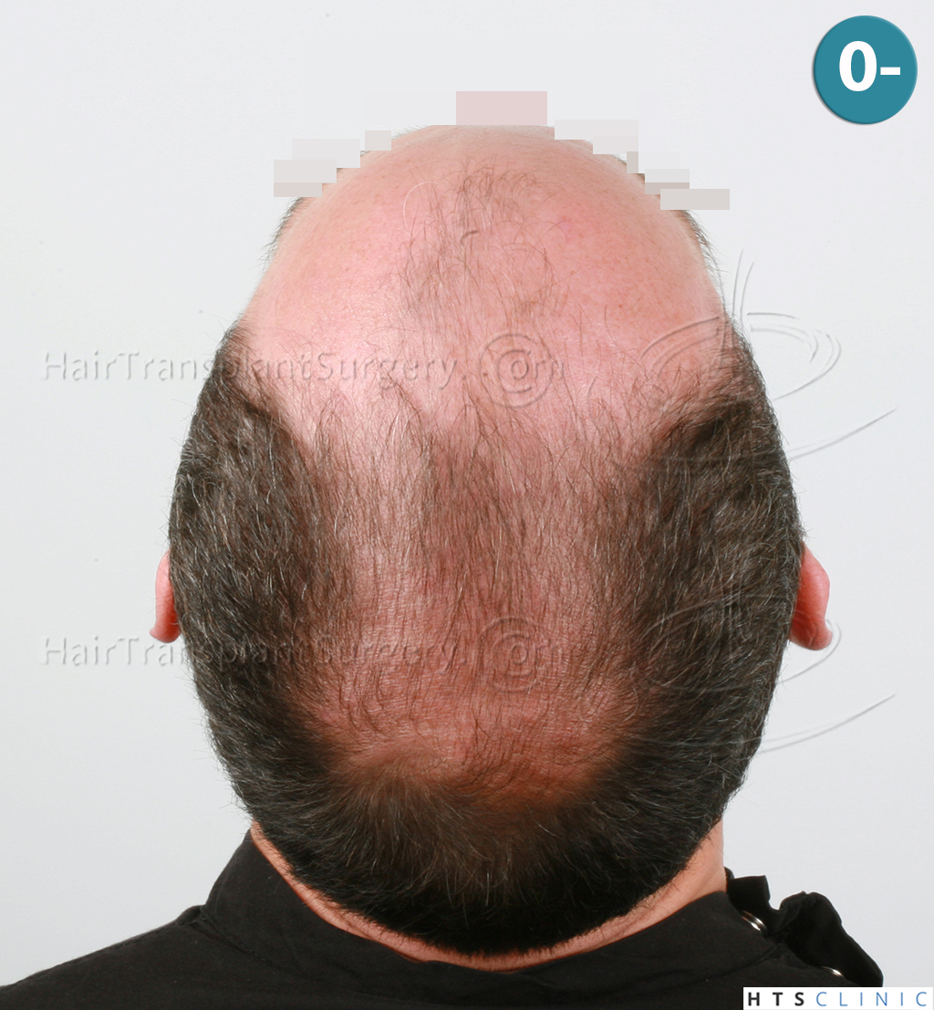 Dr.Devroye-HTS-clinic-3178-FUE-NW-VI-6.jpg
