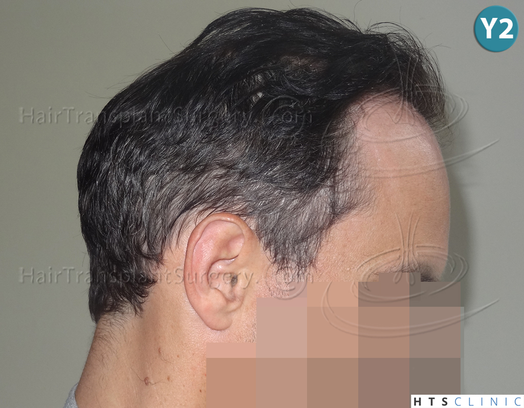 Dr.Devroye-HTS-clinic-3178-FUE-NW-VI-24.jpg