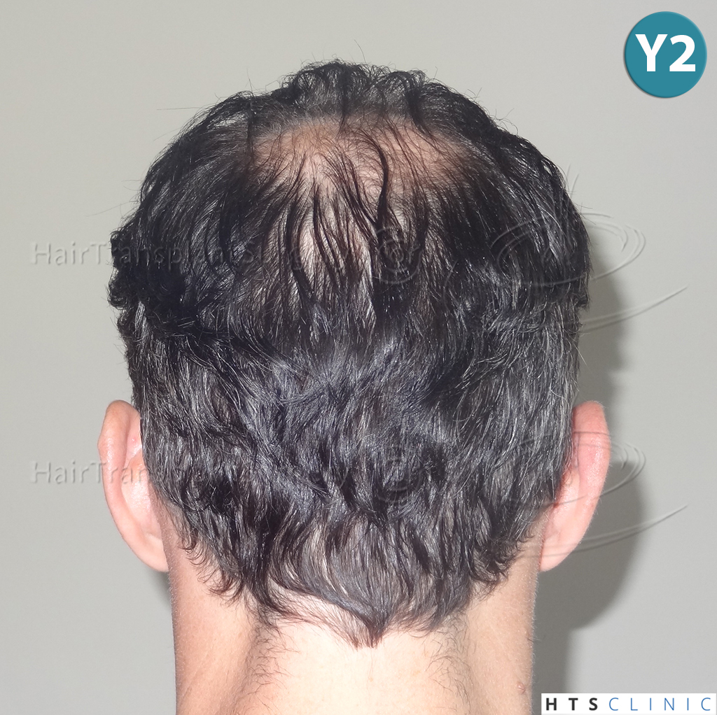 Dr.Devroye-HTS-clinic-3178-FUE-NW-VI-25.jpg