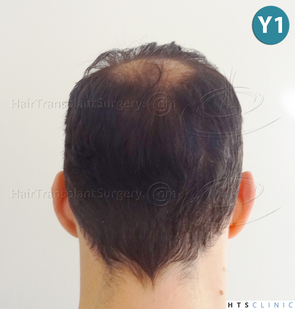 Dr.Devroye-HTS-clinic-3178-FUE-NW-VI-20.jpg
