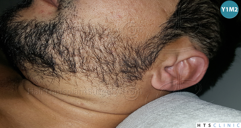 Dr.Devroye-HTS-Clinic-1124-FUE-Beard-18.jpg