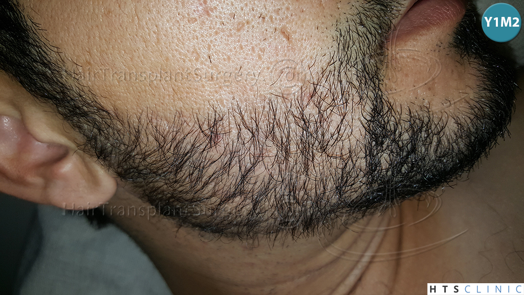 Dr.Devroye-HTS-Clinic-1124-FUE-Beard-19.jpg