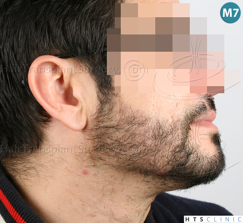 Dr.Devroye-HTS-Clinic-1124-FUE-Beard-17.jpg