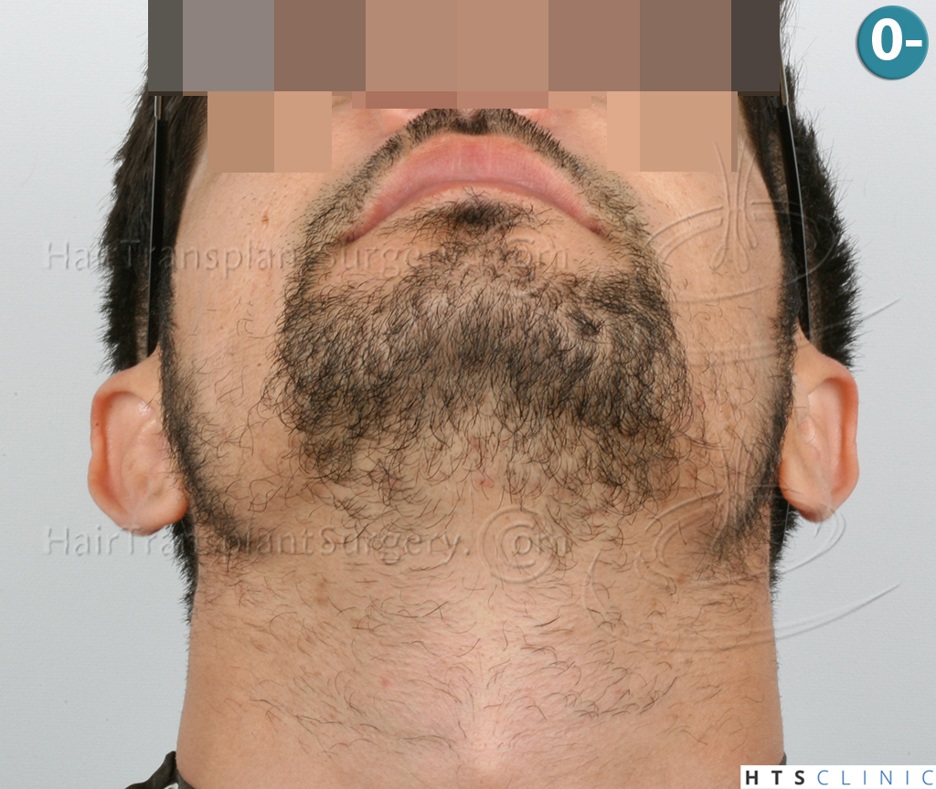Dr.Devroye-HTS-Clinic-1124-FUE-Beard-2.jpg