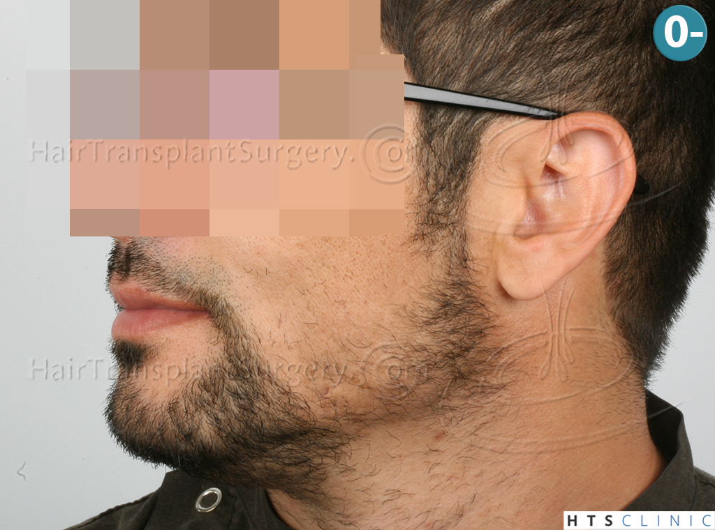 Dr.Devroye-HTS-Clinic-1124-FUE-Beard-3.jpg
