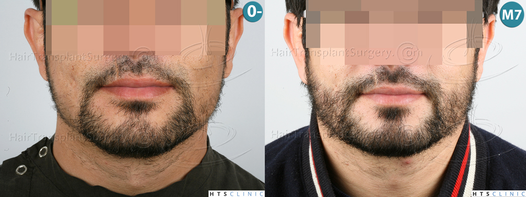 Dr.Devroye-HTS-Clinic-1124-FUE-Beard-Montage1.jpg
