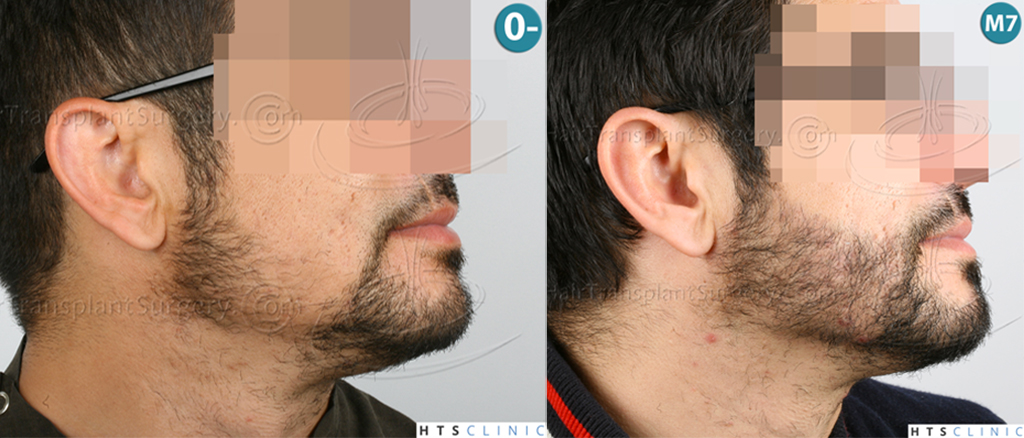 Dr.Devroye-HTS-Clinic-1124-FUE-Beard-Montage3.jpg