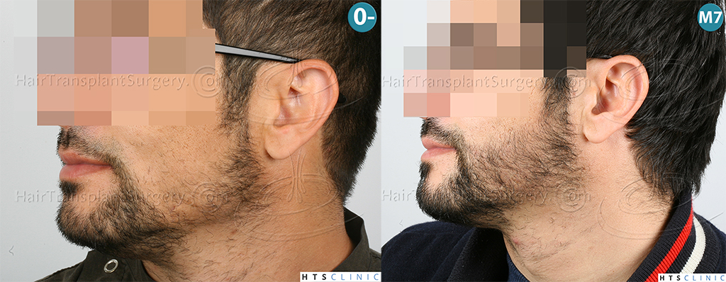 Dr.Devroye-HTS-Clinic-1124-FUE-Beard-Montage2.jpg