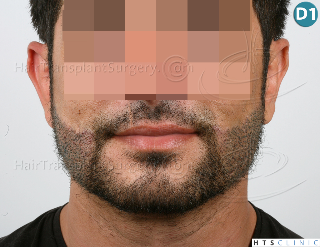 Dr.Devroye-HTS-Clinic-1124-FUE-Beard-8.jpg