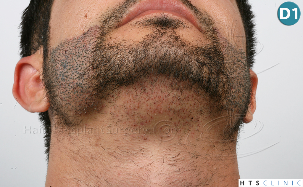 Dr.Devroye-HTS-Clinic-1124-FUE-Beard-9.jpg