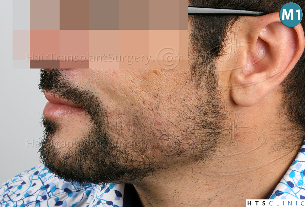 Dr.Devroye-HTS-Clinic-1124-FUE-Beard-13.jpg