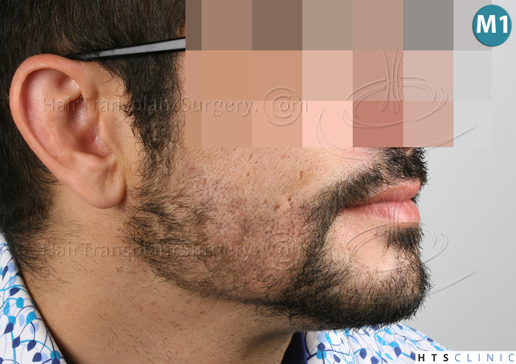 Dr.Devroye-HTS-Clinic-1124-FUE-Beard-14.jpg