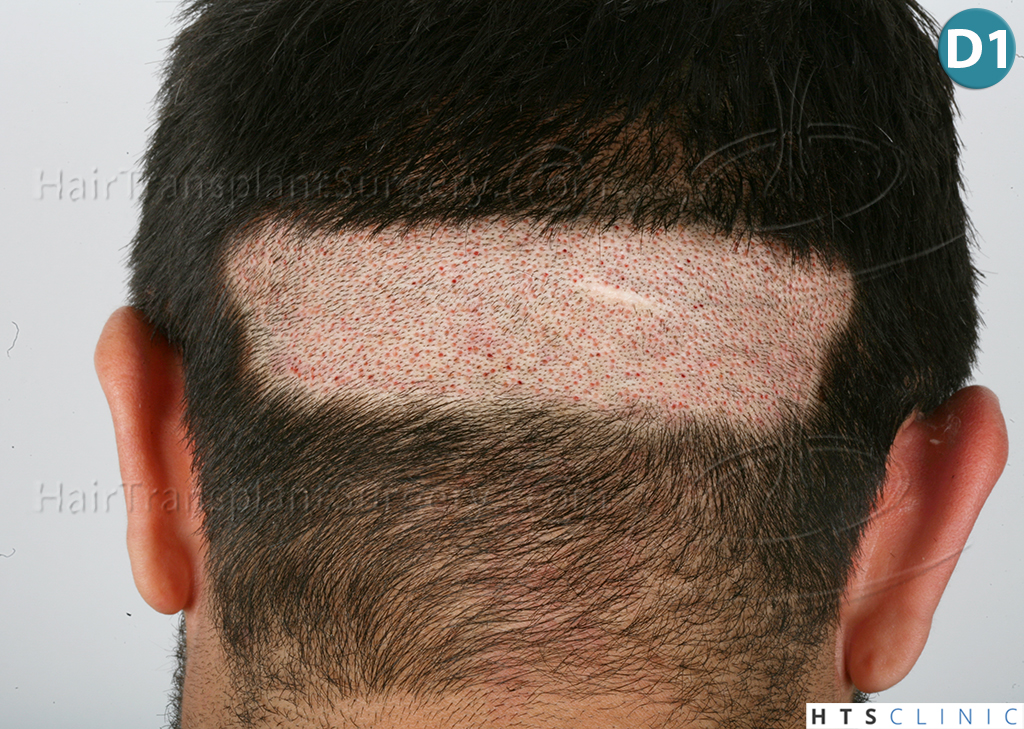 Dr.Devroye-HTS-Clinic-1124-FUE-Beard-12.jpg