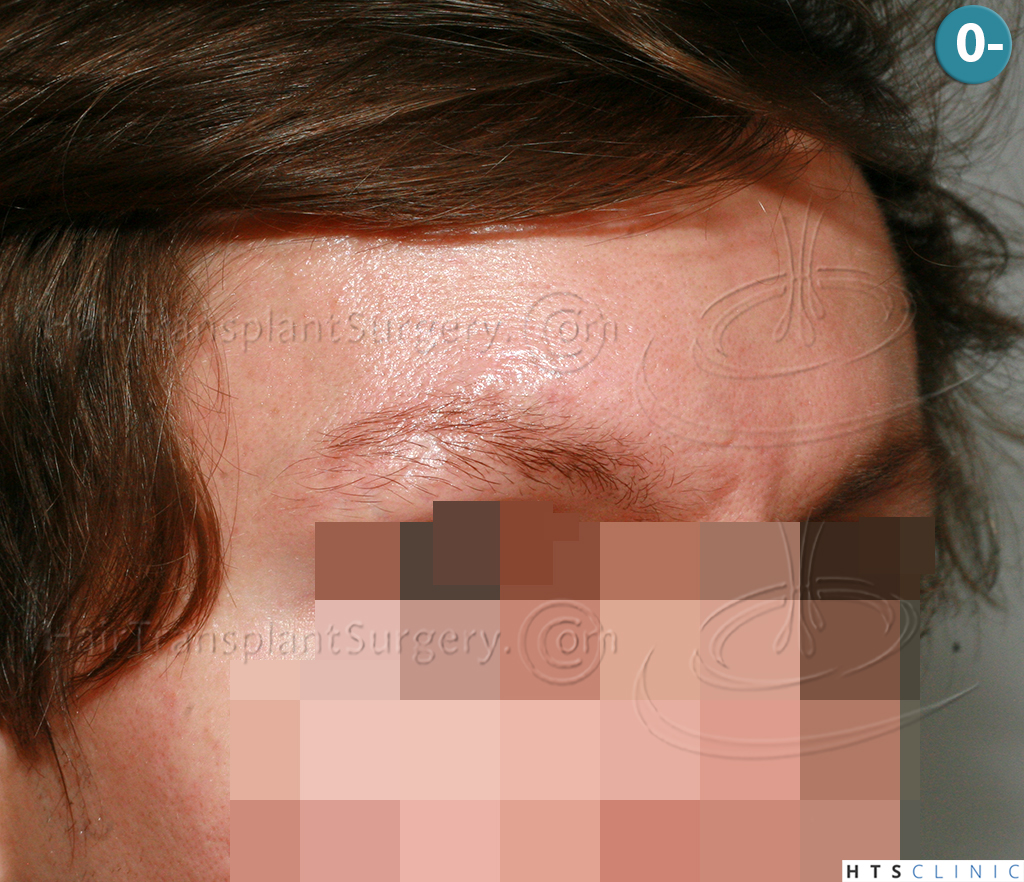 Dr.Devroye-HTS-Clinic-402-FUT-Eyebrows-3.jpg