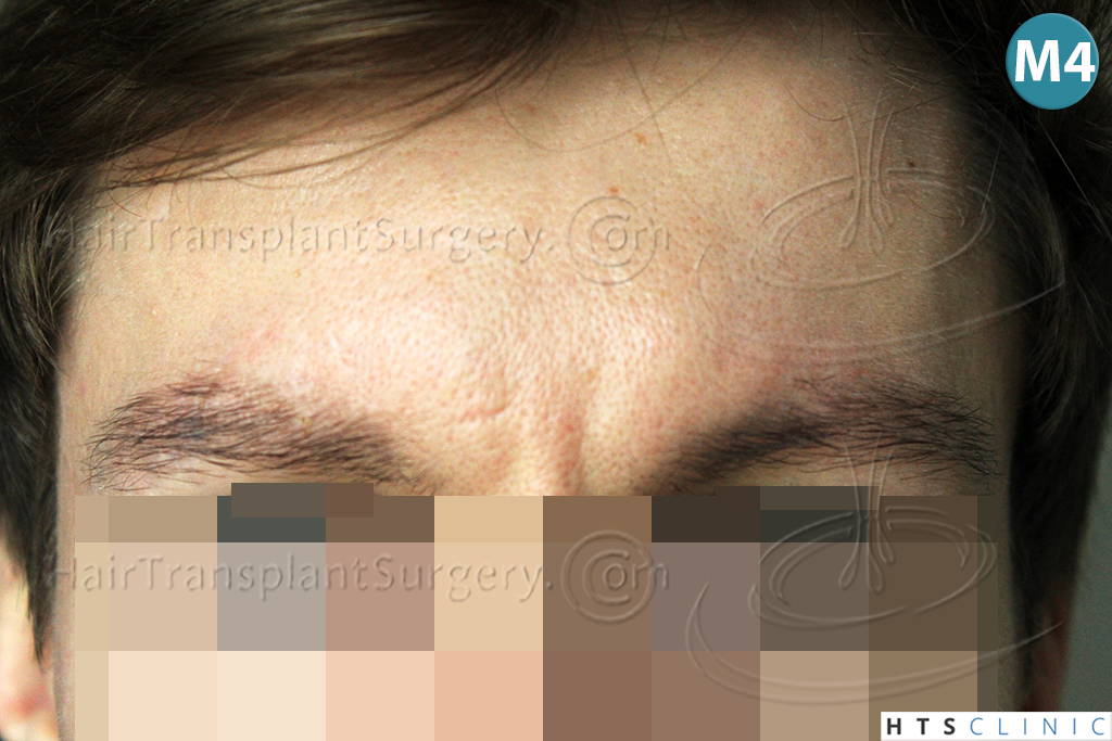 Dr.Devroye-HTS-Clinic-402-FUT-Eyebrows-5.jpg