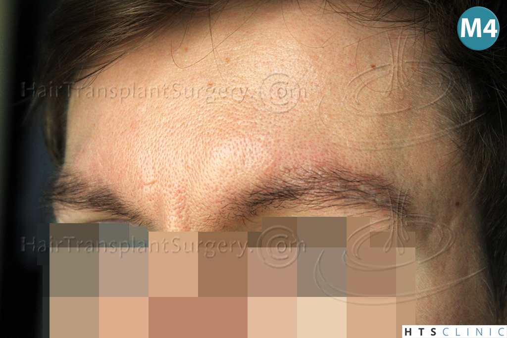 Dr.Devroye-HTS-Clinic-402-FUT-Eyebrows-6.jpg