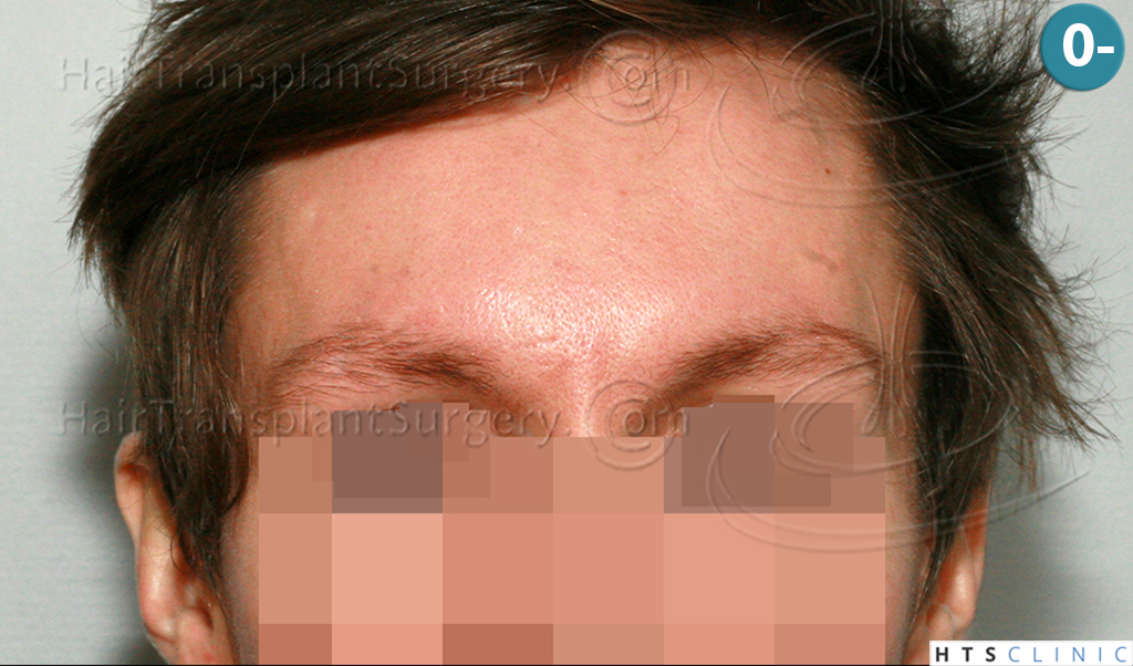 Dr.Devroye-HTS-Clinic-402-FUT-Eyebrows-1.jpg