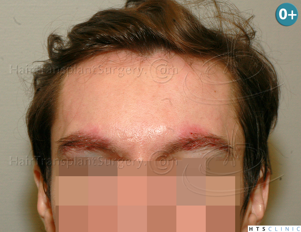Dr.Devroye-HTS-Clinic-402-FUT-Eyebrows-4.jpg