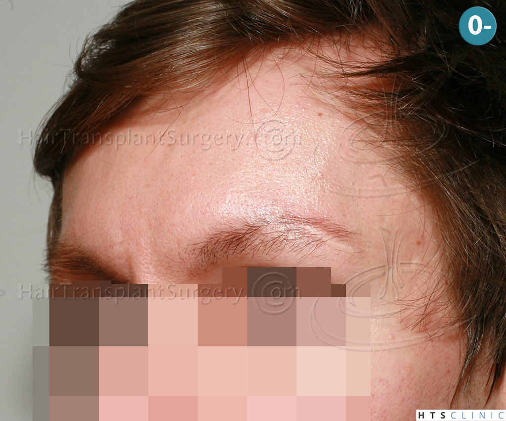 Dr.Devroye-HTS-Clinic-402-FUT-Eyebrows-2.jpg