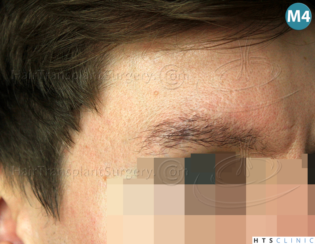 Dr.Devroye-HTS-Clinic-402-FUT-Eyebrows-7.jpg