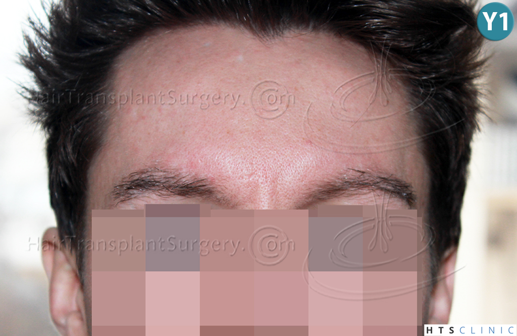 Dr.Devroye-HTS-Clinic-402-FUT-Eyebrows-8.jpg