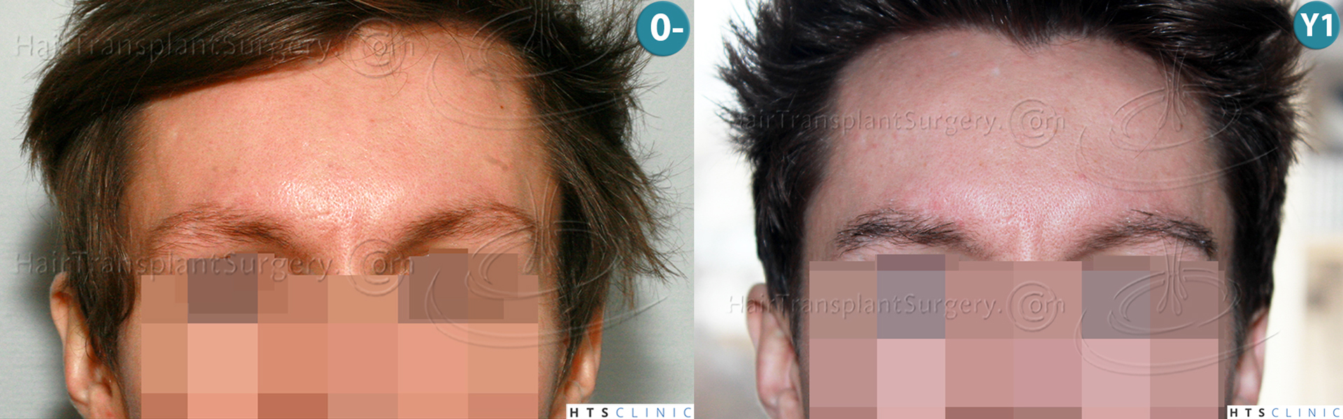 Dr.Devroye-HTS-Clinic-402-FUT-Eyebrows-Montage1.jpg