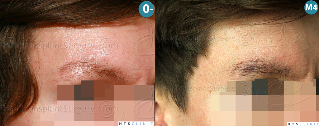 Dr.Devroye-HTS-Clinic-402-FUT-Eyebrows-Montage3.jpg