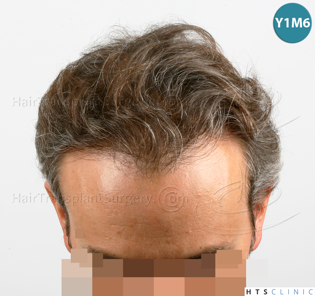 Dr.Devroye-HTS-Clinic-3202-FUT-NWIIIA-12.jpg
