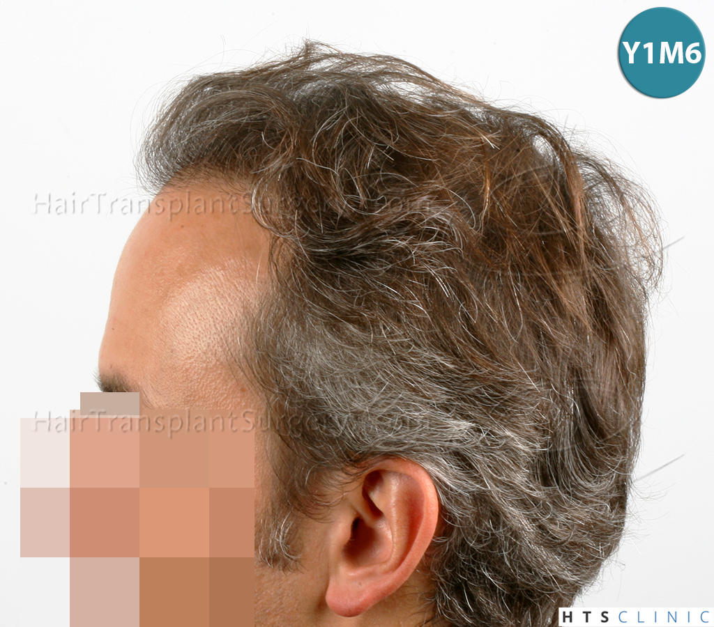 Dr.Devroye-HTS-Clinic-3202-FUT-NWIIIA-15.jpg