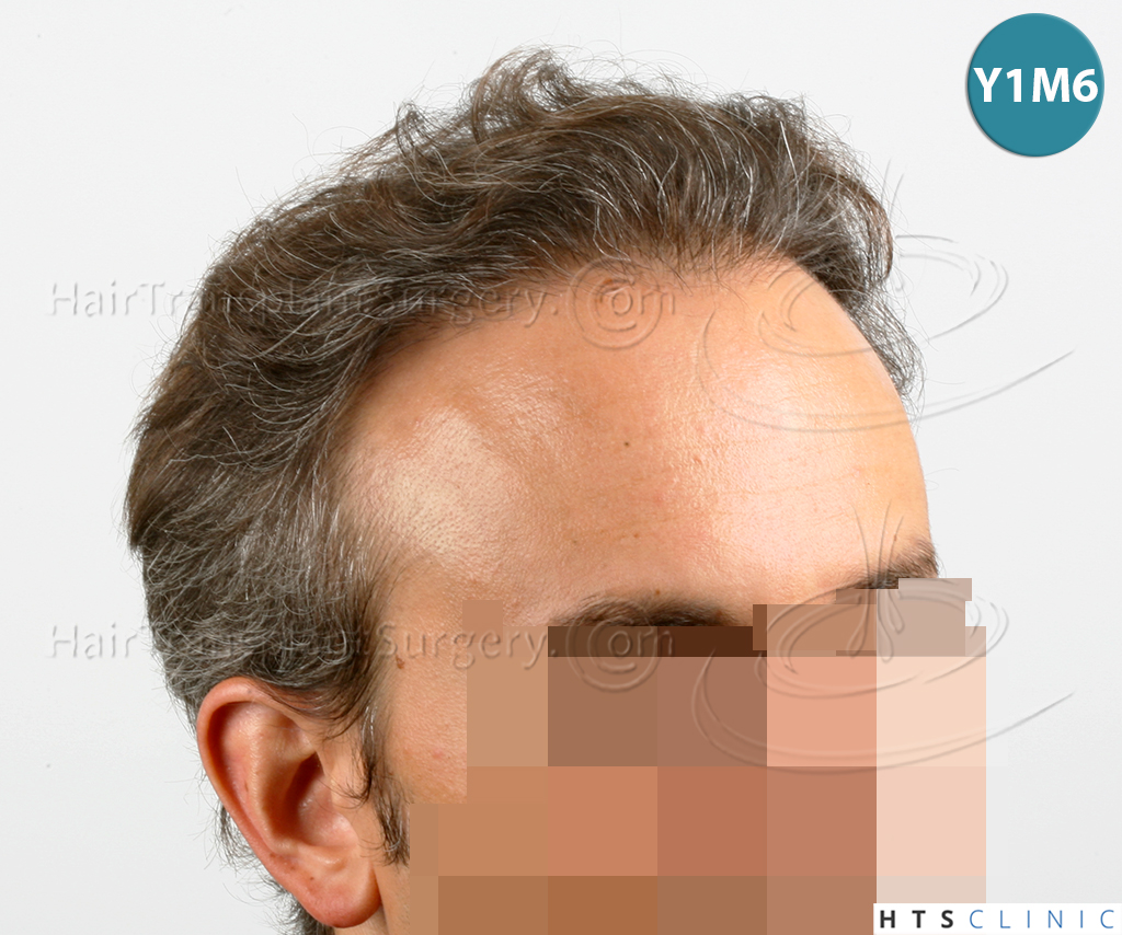 Dr.Devroye-HTS-Clinic-3202-FUT-NWIIIA-16.jpg