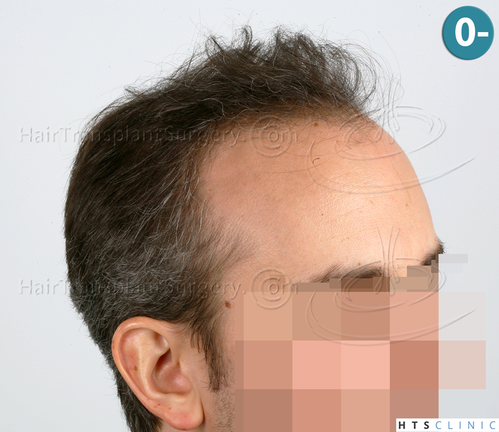 Dr.Devroye-HTS-Clinic-3202-FUT-NWIIIA-4.jpg