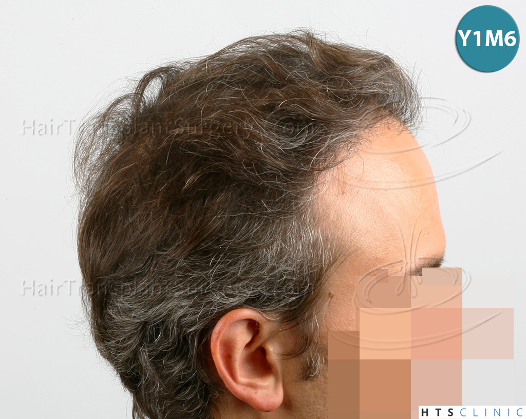 Dr.Devroye-HTS-Clinic-3202-FUT-NWIIIA-17.jpg