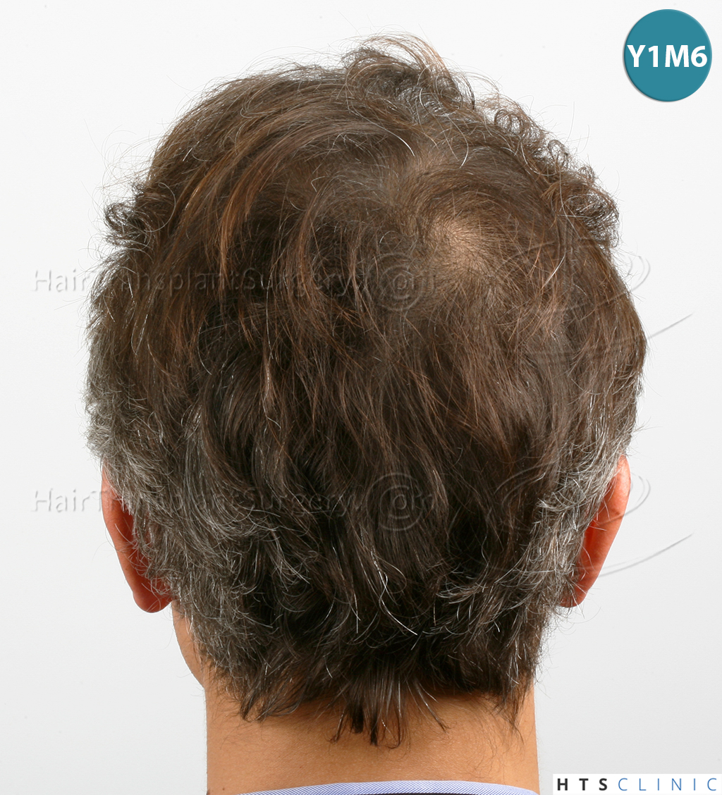 Dr.Devroye-HTS-Clinic-3202-FUT-NWIIIA-18.jpg
