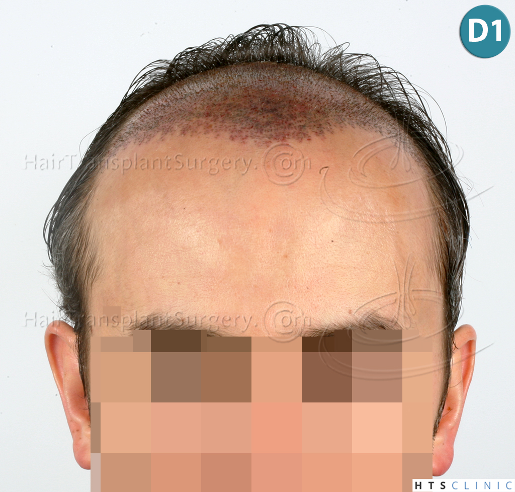 Dr.Devroye-HTS-Clinic-3202-FUT-NWIIIA-7.jpg
