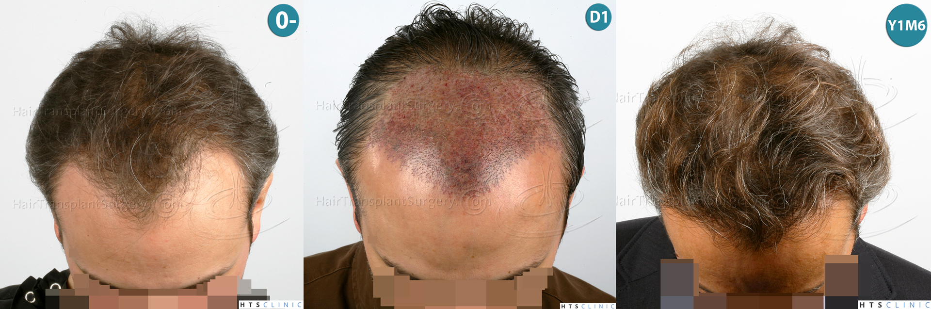 Dr.Devroye-HTS-Clinic-3202-FUT-NWIIIA-Montage1.jpg