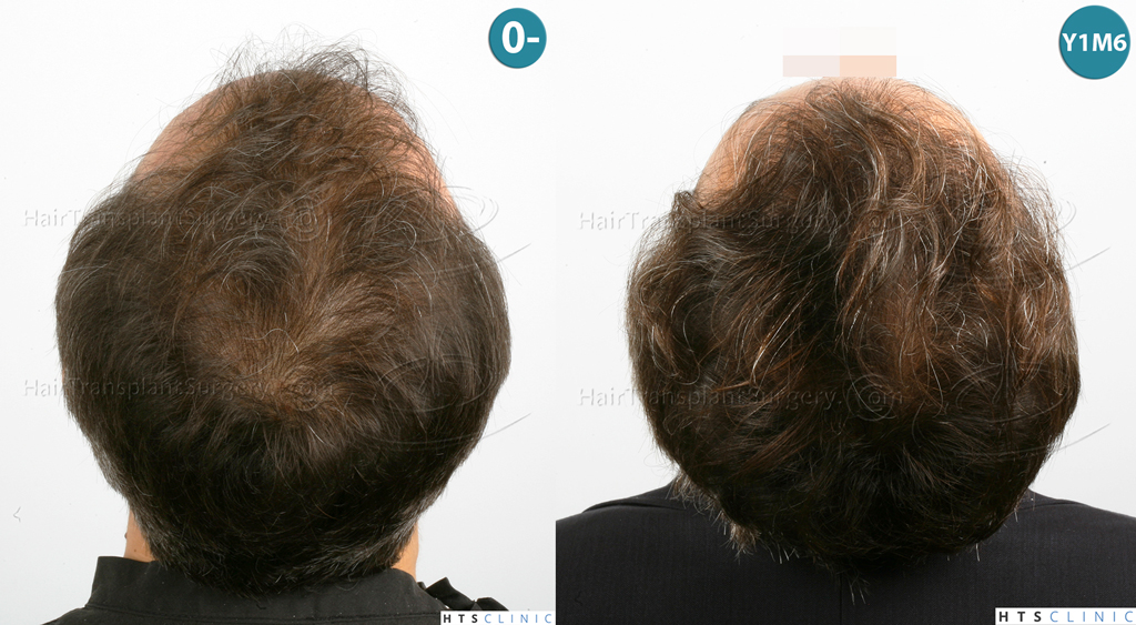 Dr.Devroye-HTS-Clinic-3202-FUT-NWIIIA-Montage4.jpg