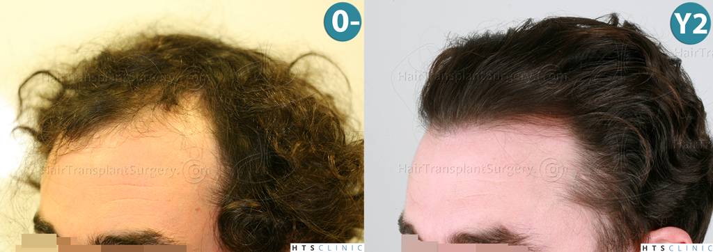 Dr.Devroye-HTS-Clinic-3290-FUT-NWIIIA-Montage3.jpg