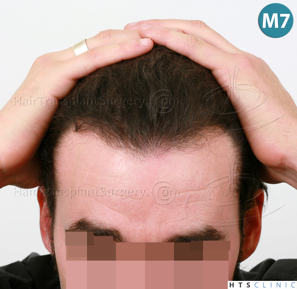 Dr.Devroye-HTS-Clinic-3290-FUT-NWIIIA-15.jpg