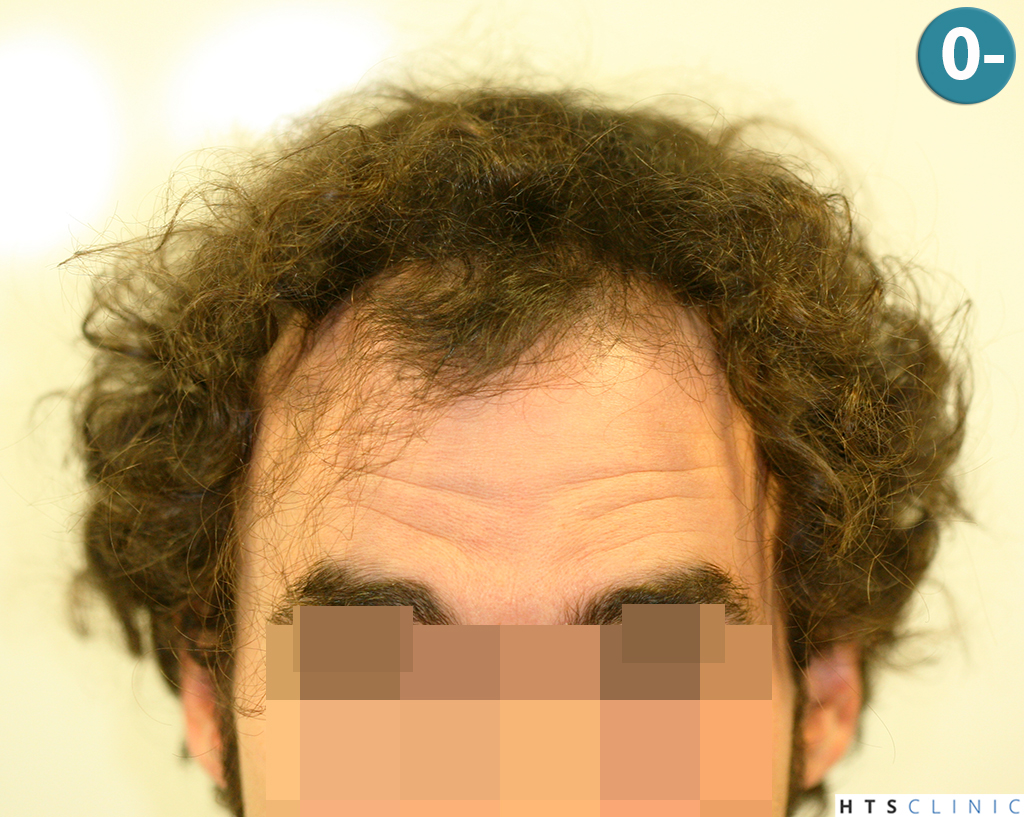 Dr.Devroye-HTS-Clinic-3290-FUT-NWIIIA-1.jpg
