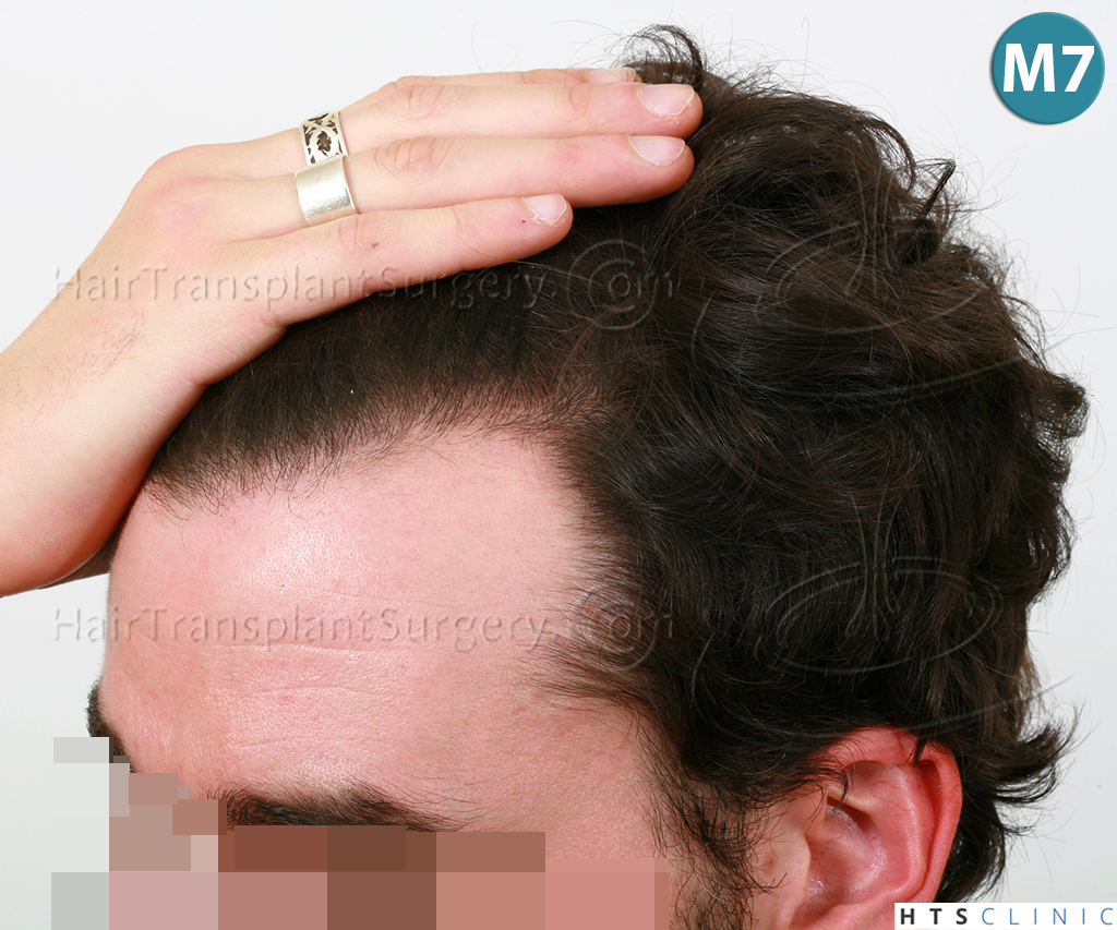 Dr.Devroye-HTS-Clinic-3290-FUT-NWIIIA-16.jpg
