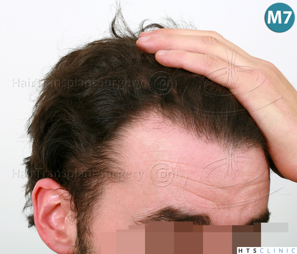 Dr.Devroye-HTS-Clinic-3290-FUT-NWIIIA-18.jpg