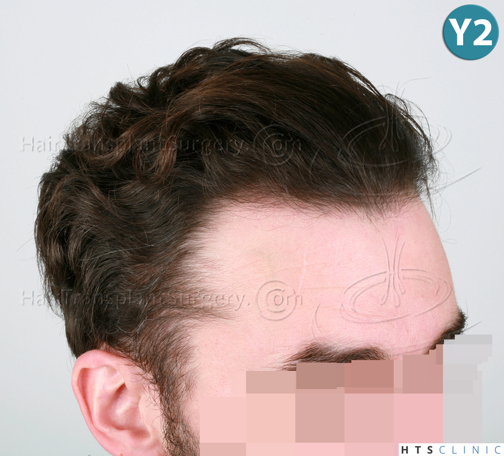 Dr.Devroye-HTS-Clinic-3290-FUT-NWIIIA-29.jpg