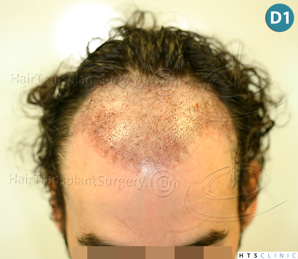 Dr.Devroye-HTS-Clinic-3290-FUT-NWIIIA-6.jpg