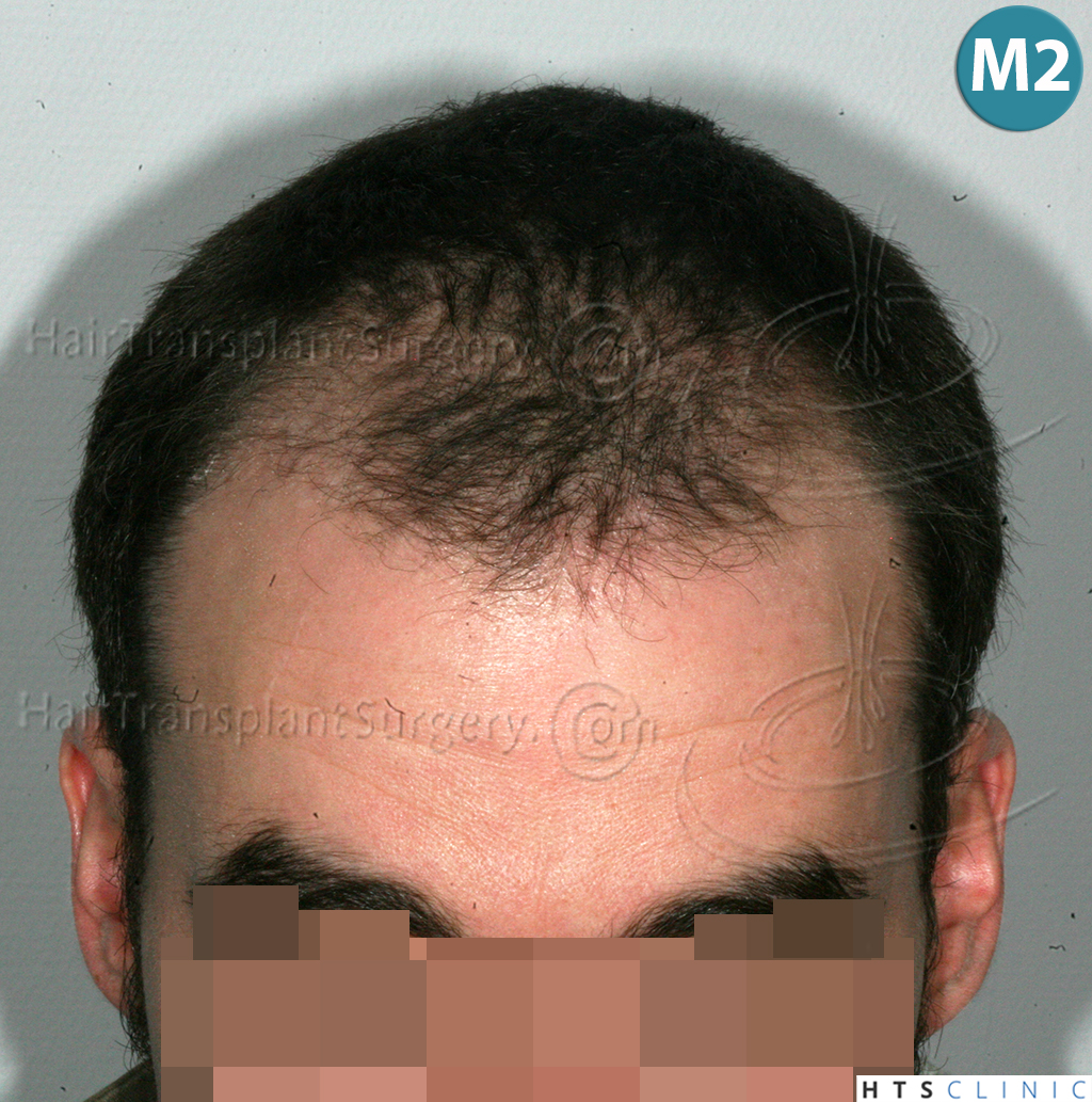 Dr.Devroye-HTS-Clinic-3290-FUT-NWIIIA-10.jpg