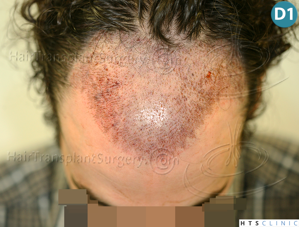 Dr.Devroye-HTS-Clinic-3290-FUT-NWIIIA-7.jpg