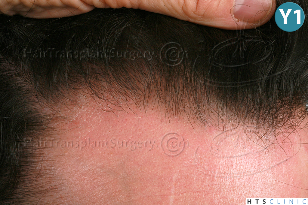 Dr.Devroye-HTS-Clinic-3290-FUT-NWIIIA-25.jpg